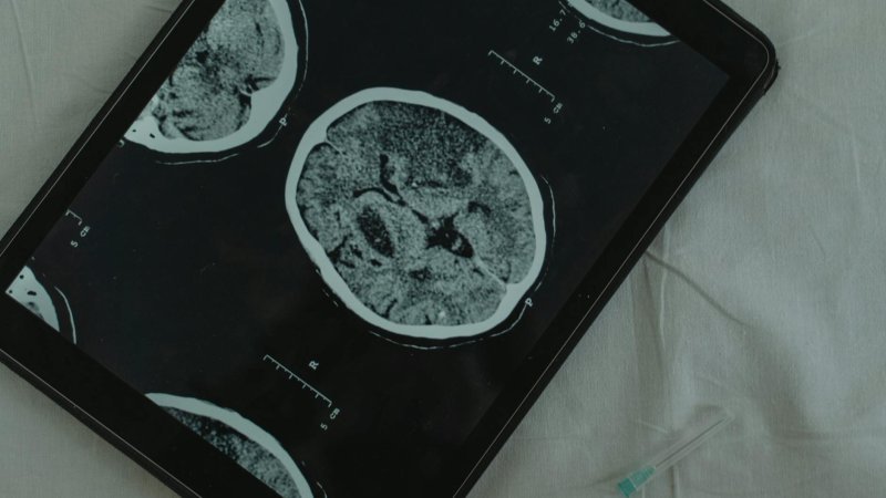 Hyperbaric Oxygen Therapy Boosts Brain Health: Discover How