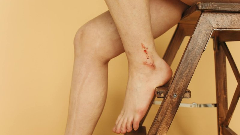 Venous Stasis Ulcers and Hyperbaric Oxygen Therapy: A Guide